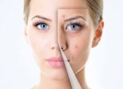 Tips Menghilangkan Jerawat Bandel dan Wajah Glowing Ala dr Zaidul Akbar