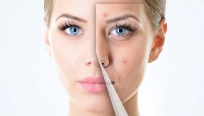 Tips Menghilangkan Jerawat Bandel dan Wajah Glowing Ala dr Zaidul Akbar