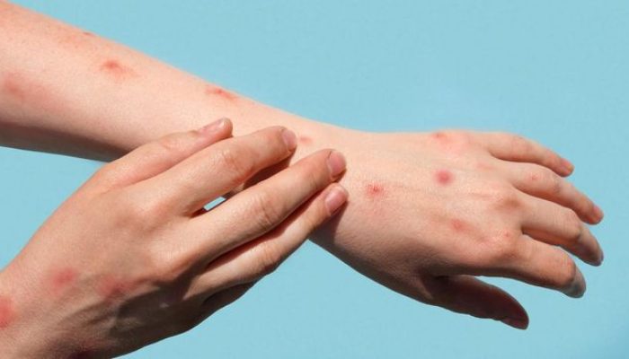 Kenali Gejalanya, Perbedaan Cacar Monyet, Cacar Air, dan Campak